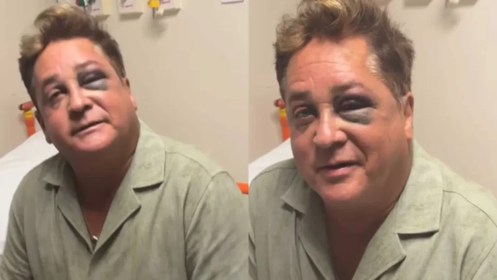 Leonardo aparece com olho roxo após queda e vai parar no hospital; entenda