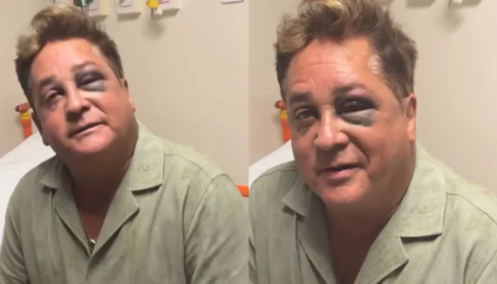 Leonardo aparece com olho roxo após queda e vai parar no hospital; entenda